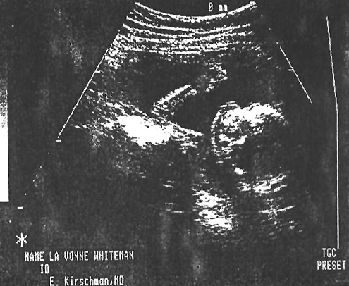 1993-05-14 Amanda 4 mos. before birth.